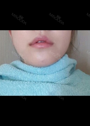 I had Smile lip lifting, Cupid’s bow lip and lip tubercle surgeries in Hyundai Aesthetics