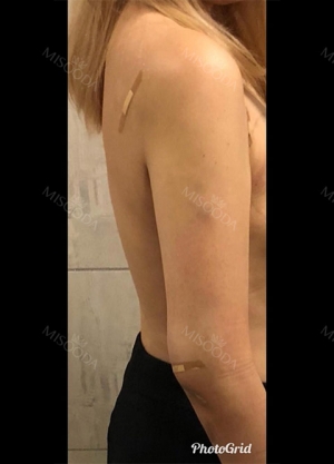 Arm Liposuction with Pretty Body Clinic