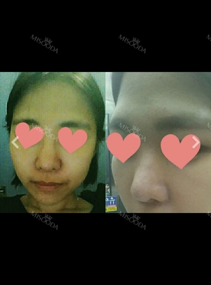 Review Hidung! Dari hidung dengan batang yang besar menjadi hidung yang diinginkan!