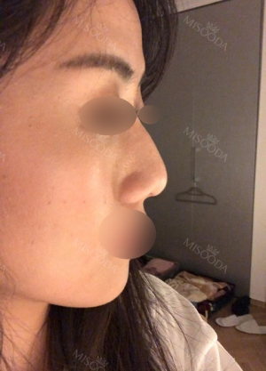 Rhinoplasty with Misooda and JW Plastic Surgery