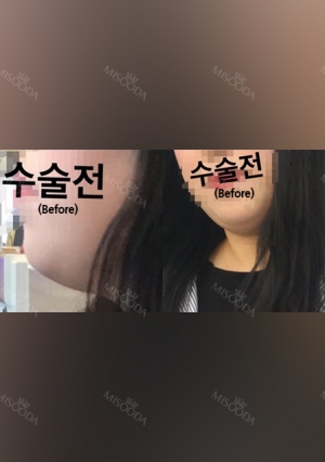 facial liposuction at Wonjin plastic surgery clinic