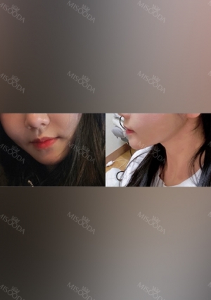 Facial liposuction, Thread Lifting