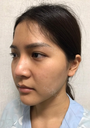 Facial Bone, Nose Surgery, Breast fat graft