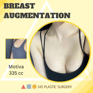 After — 345 PLASTIC SURGERY