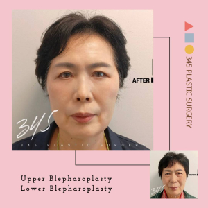 After — 345 PLASTIC SURGERY
