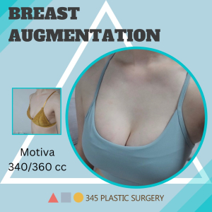 After — 345 PLASTIC SURGERY