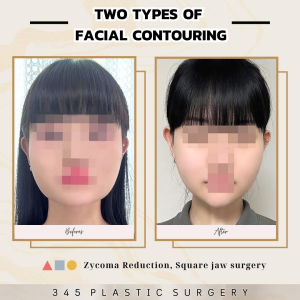 After — 345 PLASTIC SURGERY