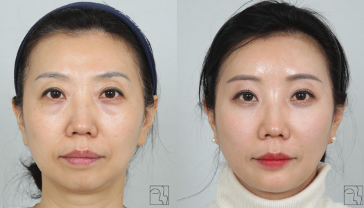 After — INIQUE Plastic Surgery