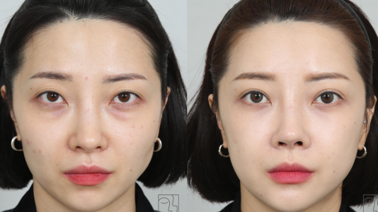 After — INIQUE Plastic Surgery