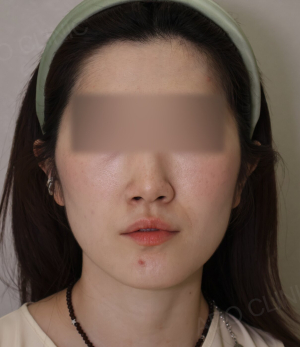 Before — Ado Clinic