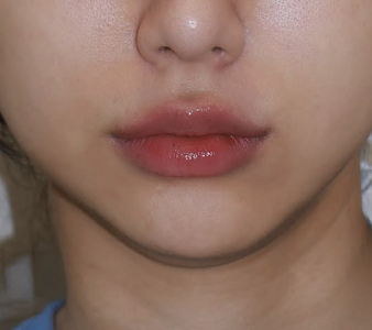 After — Ado Clinic