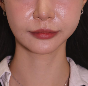 After — Ado Clinic