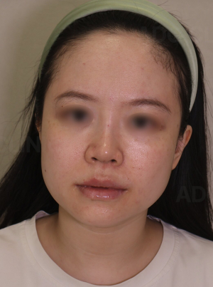 After — Ado Clinic