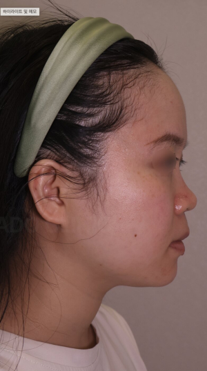 Before — Ado Clinic
