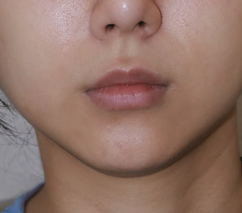 Before — Ado Clinic