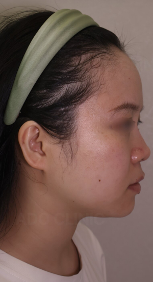 After — Ado Clinic