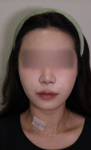 After — Ado Clinic
