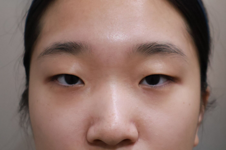 Before — RUBY Plastic Surgery