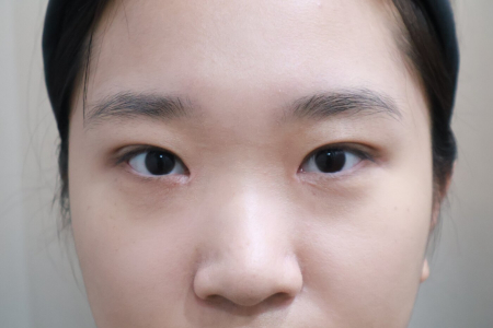 After — RUBY Plastic Surgery