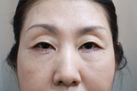 After — RUBY Plastic Surgery