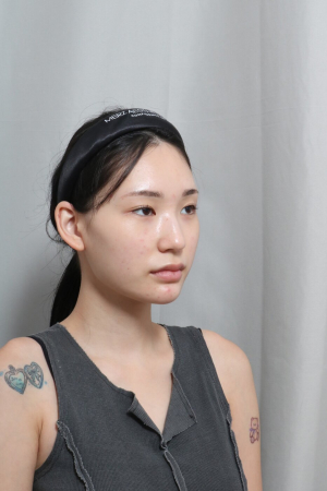 Before — RUBY Plastic Surgery