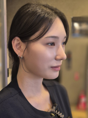 After — RUBY Plastic Surgery