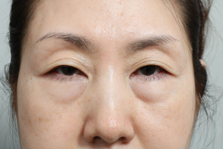 Before — RUBY Plastic Surgery
