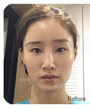 Before — 韩国必妩整形医院