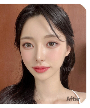 After — 韩国必妩整形医院