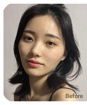 Before — 韩国必妩整形医院