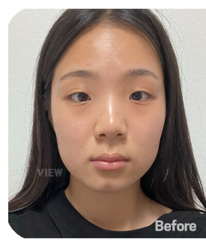Before — 韩国必妩整形医院