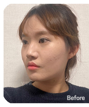 Before — 韩国必妩整形医院