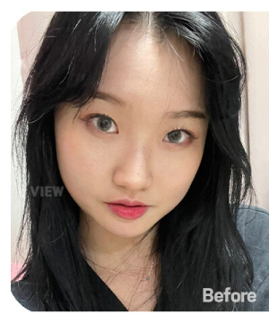 Before — 韩国必妩整形医院