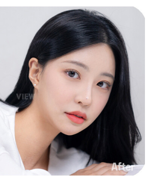After — 韩国必妩整形医院
