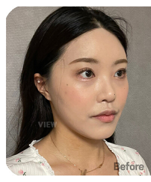 Before — 韩国必妩整形医院