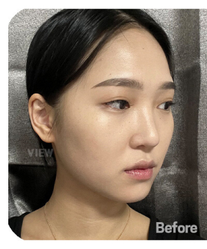 Before — 韩国必妩整形医院