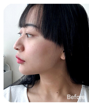 Before — 韩国必妩整形医院