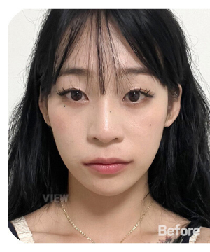 Before — 韩国必妩整形医院