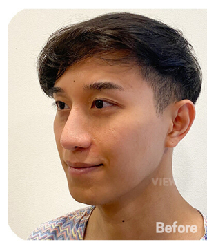 Before — 韩国必妩整形医院