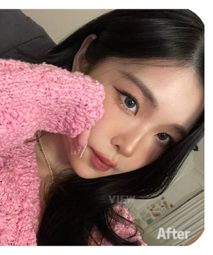 After — 韩国必妩整形医院