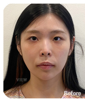 Before — 韩国必妩整形医院