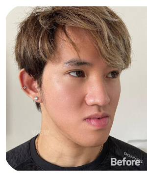Before — 韩国必妩整形医院