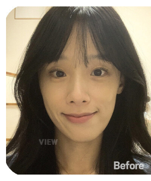 Before — 韩国必妩整形医院