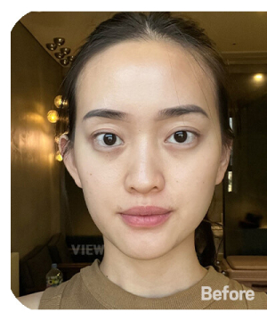 Before — 韩国必妩整形医院