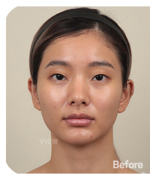 Before — 韩国必妩整形医院