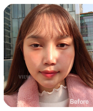Before — 韩国必妩整形医院
