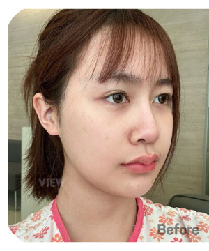 Before — 韩国必妩整形医院