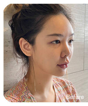 Before — 韩国必妩整形医院