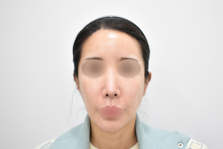 After — RESPECT Plastic Surgery