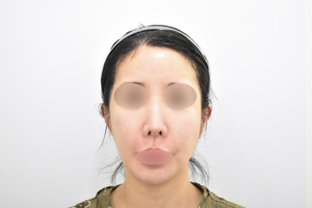 Before — RESPECT Plastic Surgery